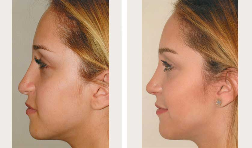 Teen girl side profile after revision rhinoplasty procedure done by Dr. Loeb Manhattan NY. 