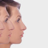 profile female before and after plastic surgery on her nose. Comparison ofwoman nose after plastic surgery