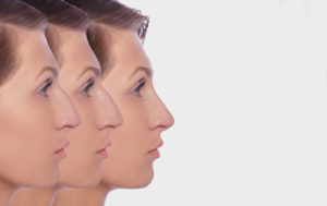 profile female before and after plastic surgery on her nose. Comparison ofwoman nose after plastic surgery