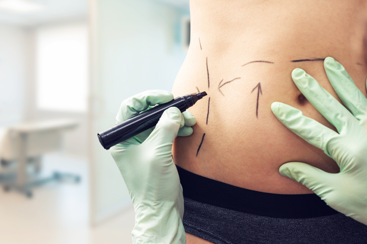 What Can I Expect at My Liposuction Consultation?