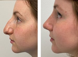 Young female before and after rhinoplasty. questions to ask at your rhinoplasty consultation