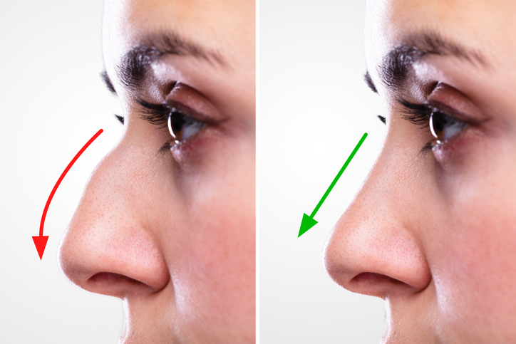 Does a Nose Job Last Forever? | Revision Rhinoplasty