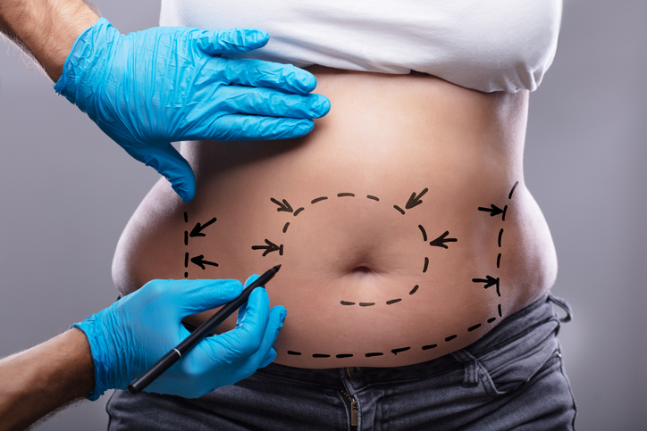 Liposuction - Mayo Clinic