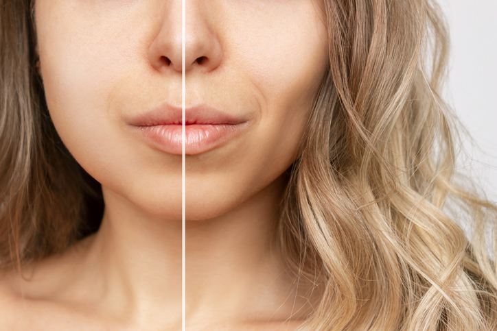 Buccal Fat Removal: Is This Hot New Trend Right for You? - Dr. Thomas Loeb