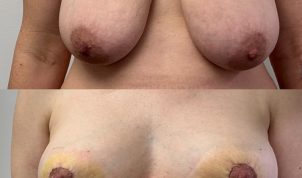 breast reduction 4 weeks post op. Before and after Thomas Loeb NYC