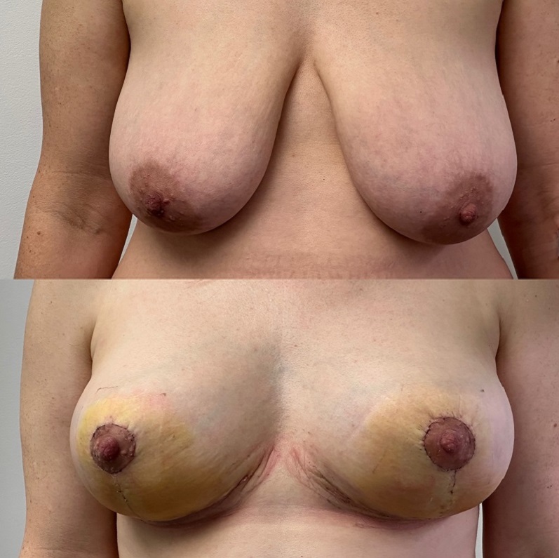 breast reduction 4 weeks post op. Before and after Thomas Loeb NYC