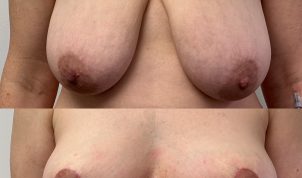 breast reduction 8 weeks post op. Before and after Thomas Loeb NYC