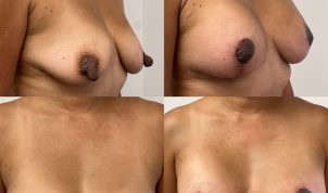 Woman after 6 weeks' post op nipple reduction.