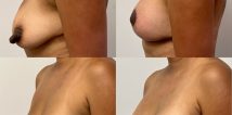 Woman post op breast lift.