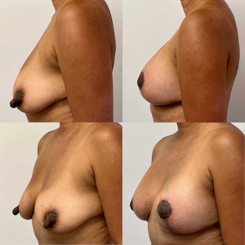 Woman post op breast lift.